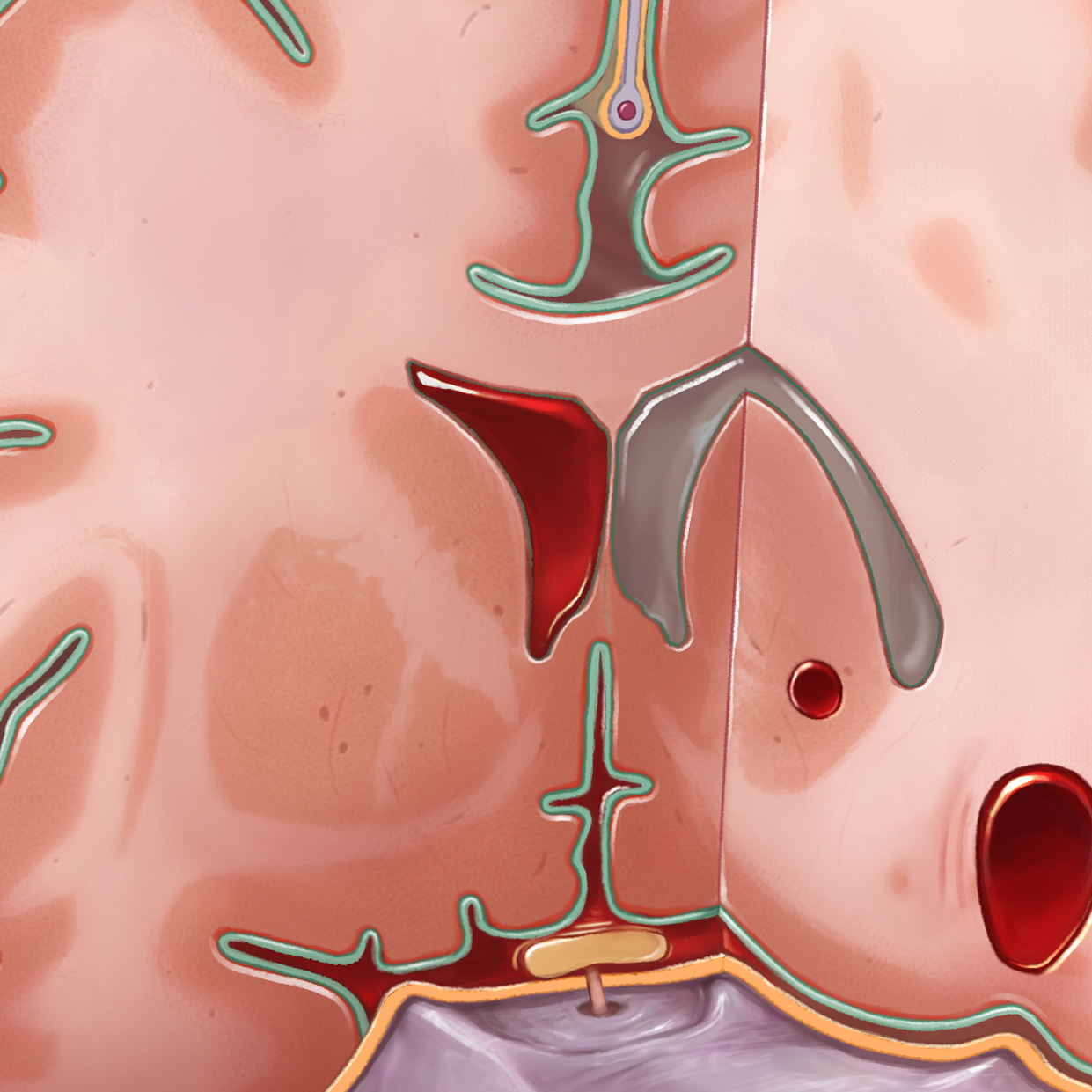 Intracranial Hemorrhage Compartments - Alexandria Dannhardt - Medical ...