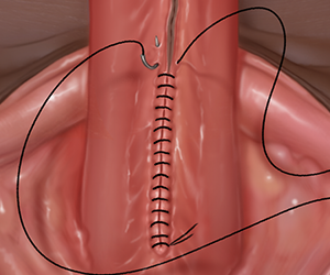 Proximal Hypospadias Repair