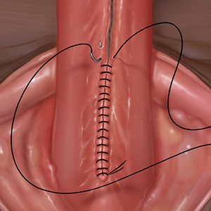 Proximal Hypospadias Repair